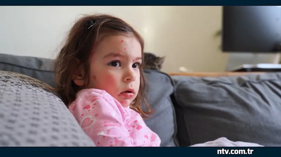 İstanbul'da Kızamık Alarmı: Unutulan Hastalık Yeniden mi Hortluyor?